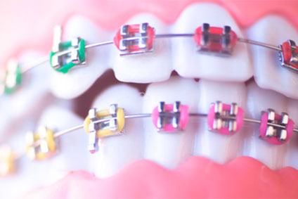 Kosmetische Zahnspange aus Metall
